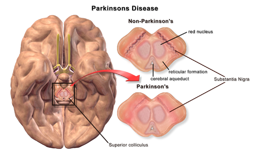 Neurological Disorders- 4- manahomeo.com