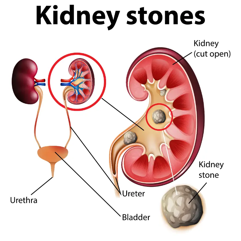 Kidney & Liver Disorders- 51685- manahomeo.com