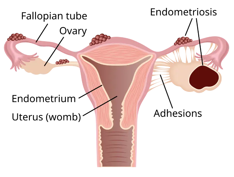 Infertility Care- Endometriosis- manahomeo.com