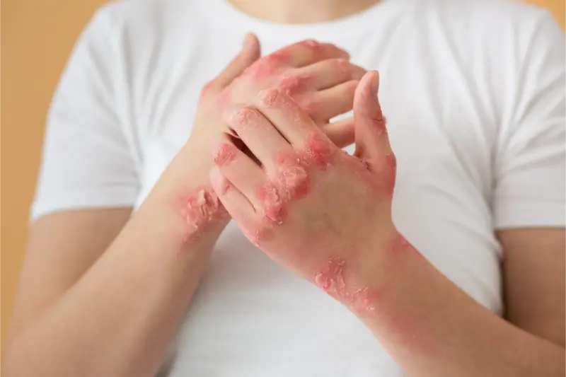 Skin Disorders- SK@- manahomeo.com