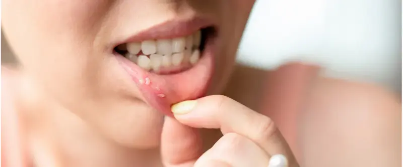 Gastrointestinal Disorders- stomatitis- manahomeo.com